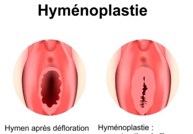 La reconstruction de l’hymen : Est-ce possible ?